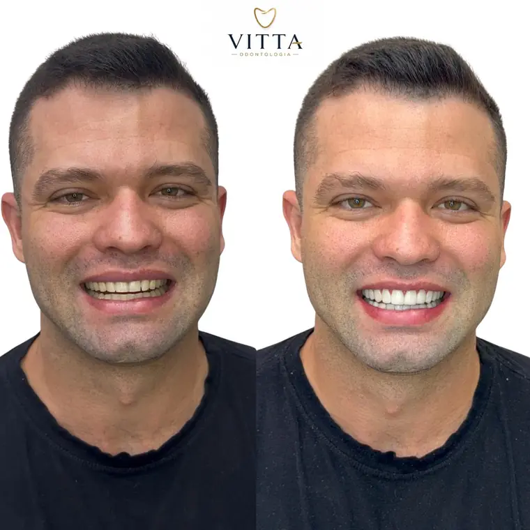 Antes e depois de lentes de resina, paciente da Vitta